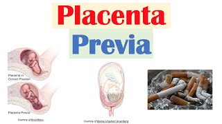 Placental Complications Explained [upl. by Alistair791]