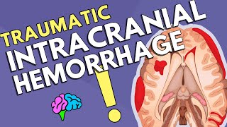 Intracranial Hemorrhage [upl. by Elahcar687]