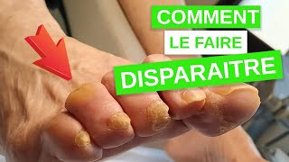 Comment faire disparaître un cor aux pieds [upl. by Jesselyn20]