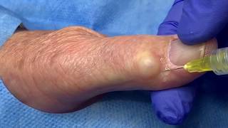 Ganglion Cyst Jelly Doughnut Hole Extraction [upl. by Noskcaj]