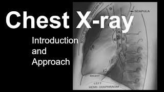 Chest Xray Introduction and Approach [upl. by Ruvolo754]