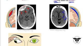 Best Stroke Recovery Hand Exercises  Stage 1 [upl. by Alolomo329]