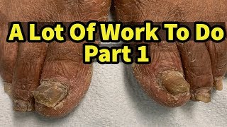 Severe Fungal Fungus Toenails A Lot Of Work To Do Part 1 [upl. by Asirahc]