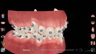 Traitement orthodontie avec bagues Dr Eric Ursat Strasbourg [upl. by Cathi]