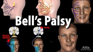 Bells Palsy Pathophysiology Symptoms Diagnosis and Treatment Animation [upl. by Hgielhsa]