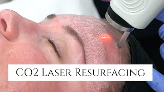 CO2 Laser Facial Rejuvenation  Fix Fine Lines and Wrinkles  Fix Sun Damage  Fix Stretch Marks [upl. by Twedy]