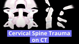 Cervical Spine Trauma on CT [upl. by Graaf]