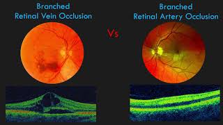 Branch Retinal Vein Occlusion BRVO  FUNDUS and OCT Findings [upl. by Oicinoid]