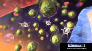 Acute Lymphocytic Leukemia ALL Animation [upl. by Moritz447]