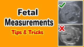 Fetal Measurements Tips and Tricks [upl. by Donoho]