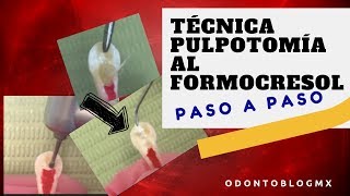 Técnica PULPOTOMÍA AL FORMOCRESOL  paso a paso [upl. by Hibbert]