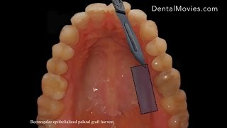 Mixed EpithelialConnective tissue graft harvesting from palate [upl. by Coucher]