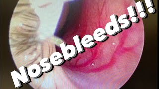 Nosebleeds epistaxis causes prevention treatments and more [upl. by Aphrodite]