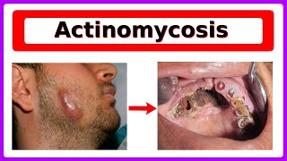 actinomycosis [upl. by Warchaw470]