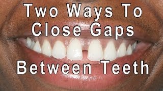 How to Close Gaps Between Teeth [upl. by Nizam424]