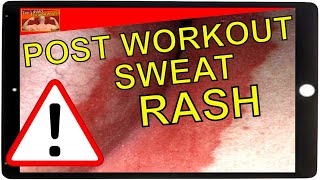 How To Treat Sweat Rash [upl. by Juliana278]