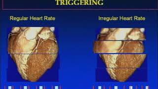 Angiogram  BRAIN angio procedure video [upl. by Notsirt189]