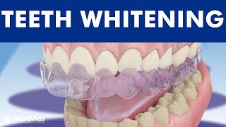 Teeth whitening  How is it done © [upl. by Eednac]