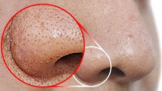 Do THIS to Remove Blackheads From Your Nose [upl. by Loughlin]