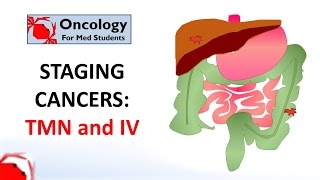 Staging cancers TNM and IIV systems [upl. by Evonne]