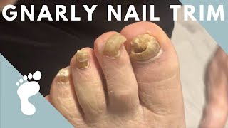 FUNGAL NAIL TRIM [upl. by Eigla761]