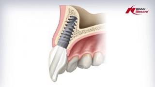 Angulated Screw Channel ASC Abutment [upl. by Gerhardt]