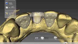 Digital Maryland bridge  Inlab Dentsply Sirona CAD CAM [upl. by Courtney]