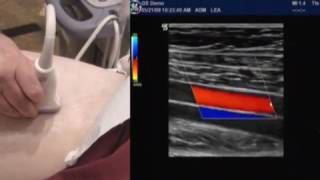 How To Lower Extremity Arterial Duplex Exam [upl. by Rod814]