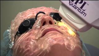 IPL Skin Rejuvenation by Jeffrey Klein MD Dermatology and Associates [upl. by Follmer880]