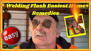 Welding Flash Easiest Home Remedies [upl. by Yluj]