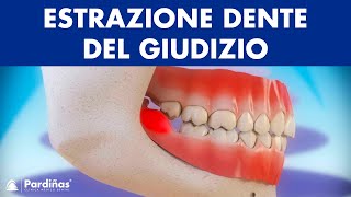 Estrazione dente del giudizio e pericoronarite © [upl. by Euqcaj]