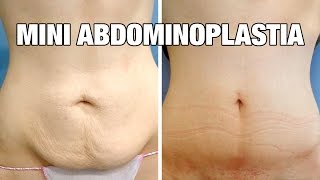 Mini Abdominoplastia antes y después  Testimonio Cristina [upl. by Adriana]