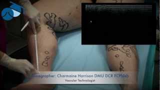 Marking an Incompetent Perforating Vein IPV ready for TRLOP [upl. by Fatimah]