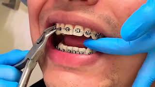 Comment retirer lappareil orthodontique [upl. by Aruat]