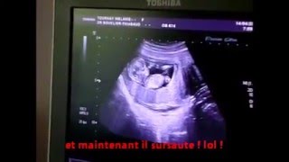 échographie 3 mois  bébé bouge déjà  ultrasound of the 3 rd month the baby already moves [upl. by Enaols]