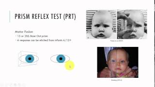 Prism Reflex Test [upl. by Scrivens594]