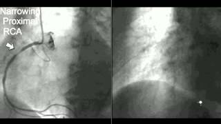 Coronary CT Angiography Cath [upl. by Anoik]