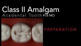 Class II Amalgam Preparation  18 MO Acadental Typodont [upl. by Nivat10]