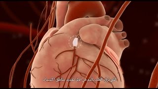 Percutaneous Coronary Intervention PCI [upl. by Coraline237]