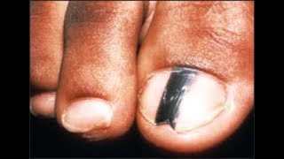 Are Black Toenail Lines amp Streaks Safe Doctor Treatment [upl. by Nyloj]