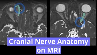 Cranial Nerve Anatomy on MRI [upl. by Ardnuhsal628]