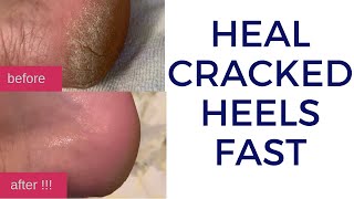 How to Quickly Heal Cracked Dry Feet amp Heels Naturally  DIY Natural Treatment for Cracked Heels [upl. by Akim]