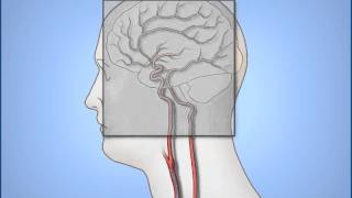 Coronary Angiogram Procedure [upl. by Koenraad]