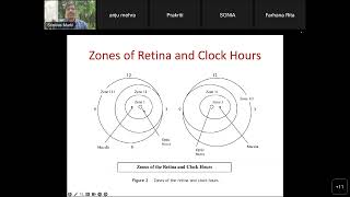 Retinopathy of Prematurity ROP [upl. by Deedee]