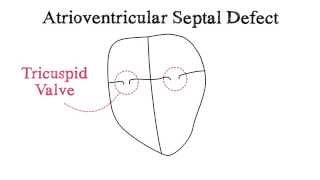 Atrioventricular Septal Defect AVSD [upl. by Ardnuas88]