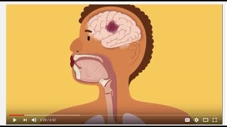 Intracranial Hemorrhage EpiduralSubduralSubarachnoid overview [upl. by Annonyw]