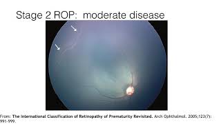 AAPOS Retinopathy of Prematurity [upl. by Armelda760]