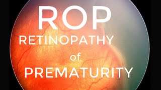 Retinopathy of prematurity ROP [upl. by Loella]