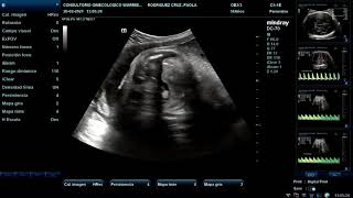 Ecografía Doppler Fetal [upl. by Oniger]