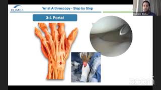 Wrist Arthroscopy Step by Step [upl. by Iras]